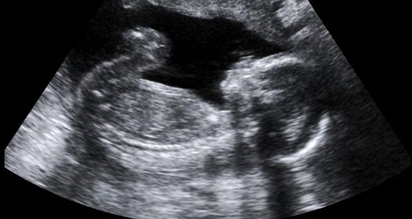 Utero
